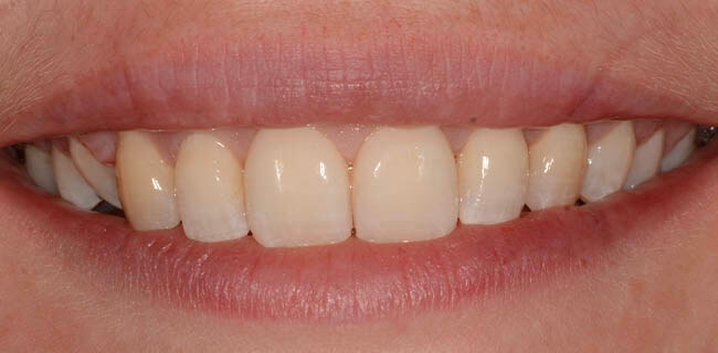 Invisalign Aligners Ripon North Yorkshire Clear Braces